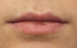 Lips before treatment