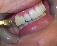 The 'AirFlow' dental detox