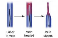 Revolutionary varicose vein treatments come to Plymouth