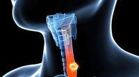 Drug trial provides hope of new treatment for some oesophageal cancer patients