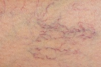 Study highlights preferred treatment for varicose veins
