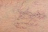 Varicose veins