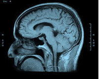 Social stigma around dementia hinders diagnosis, care and research