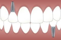 5 benefits of dental implants